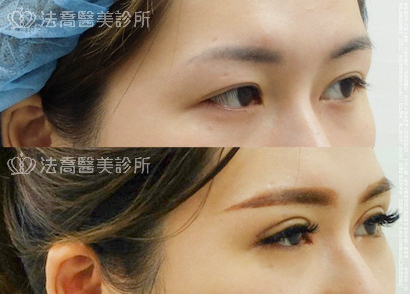 法喬醫美診所,邱浚彥,割雙眼皮