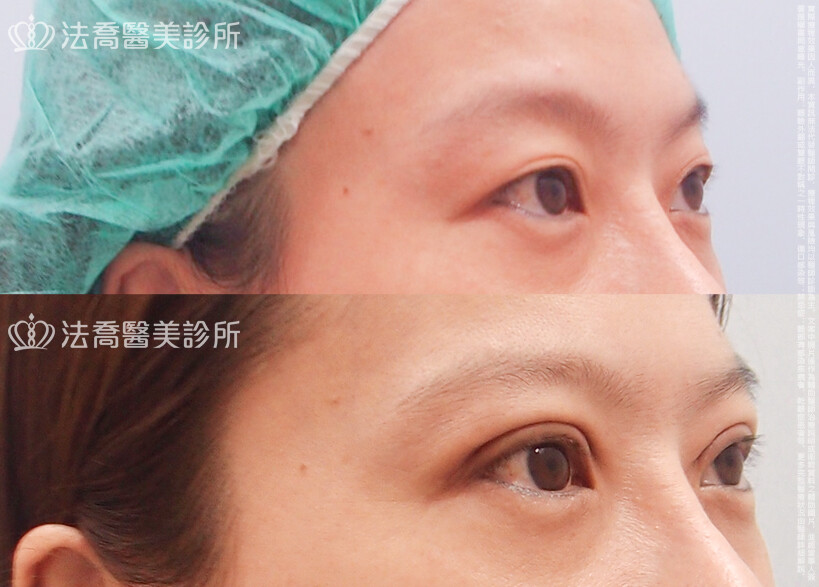 法喬醫美診所,邱浚彥,割雙眼皮
