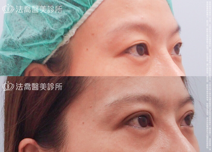 法喬醫美診所,邱浚彥,割雙眼皮