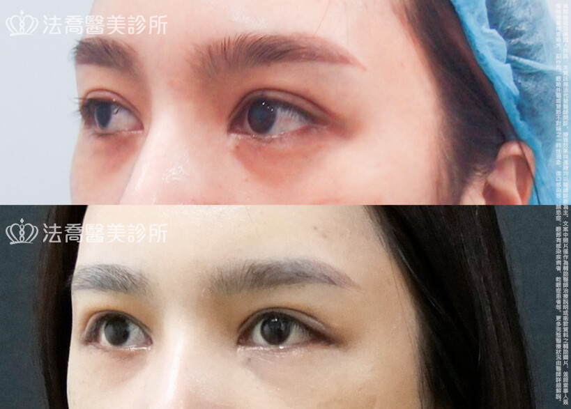 法喬醫美診所,邱浚彥,割雙眼皮,眼瞼肌提拉術,開眼頭,開眼尾