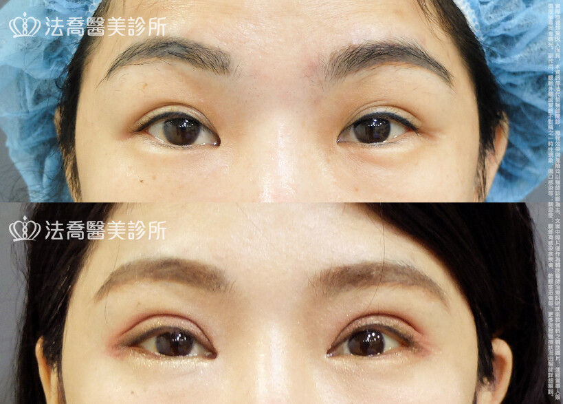 法喬醫美診所,邱浚彥,割雙眼皮,眼瞼肌提拉術,開眼頭,開眼尾