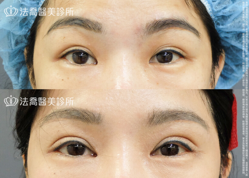 法喬醫美診所,邱浚彥,割雙眼皮,眼瞼肌提拉術,開眼頭,開眼尾