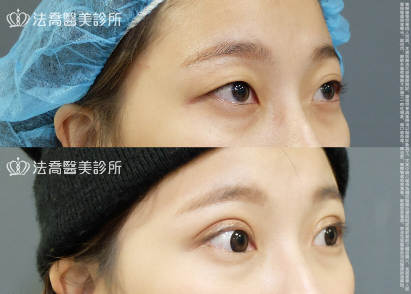 法喬醫美診所,邱浚彥,割雙眼皮,眼瞼肌提拉術