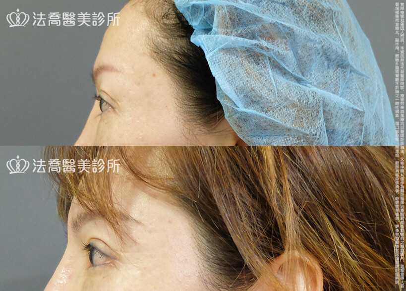 法喬醫美診所,邱浚彥,割雙眼皮,眼瞼肌提拉術