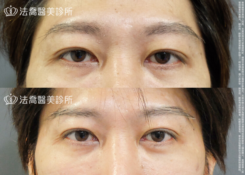 法喬醫美診所,邱浚彥,割雙眼皮,眼瞼肌提拉術