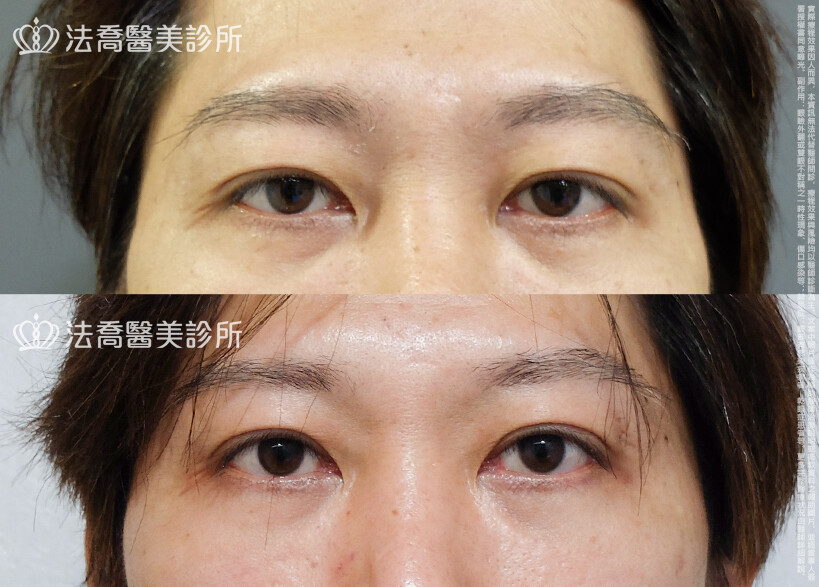 法喬醫美診所,邱浚彥,割雙眼皮,眼瞼肌提拉術