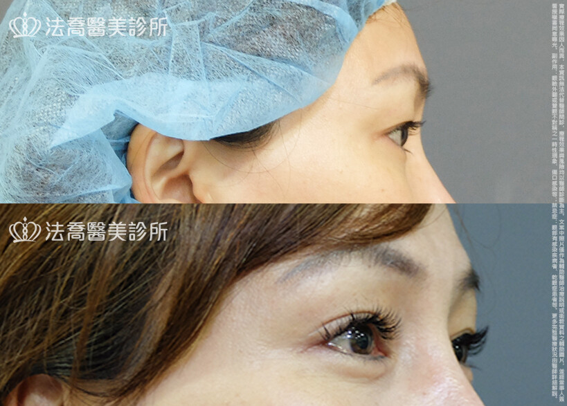 法喬醫美診所,邱浚彥,割雙眼皮,眼瞼肌提拉術