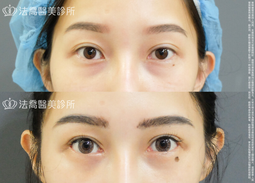 法喬醫美診所 邱浚彥醫師,割雙眼皮,眼瞼肌提拉術,開眼頭,開眼尾
