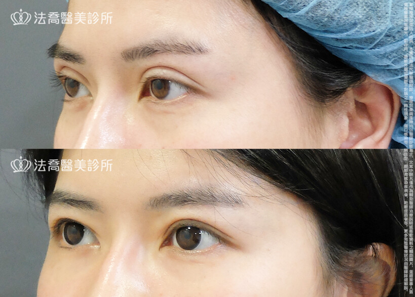 法喬醫美診所,邱浚彥,割雙眼皮,眼瞼肌提拉術