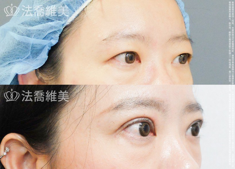 法喬醫美診所,邱浚彥,割雙眼皮