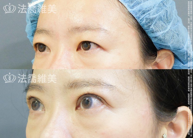 法喬醫美診所,邱浚彥,割雙眼皮
