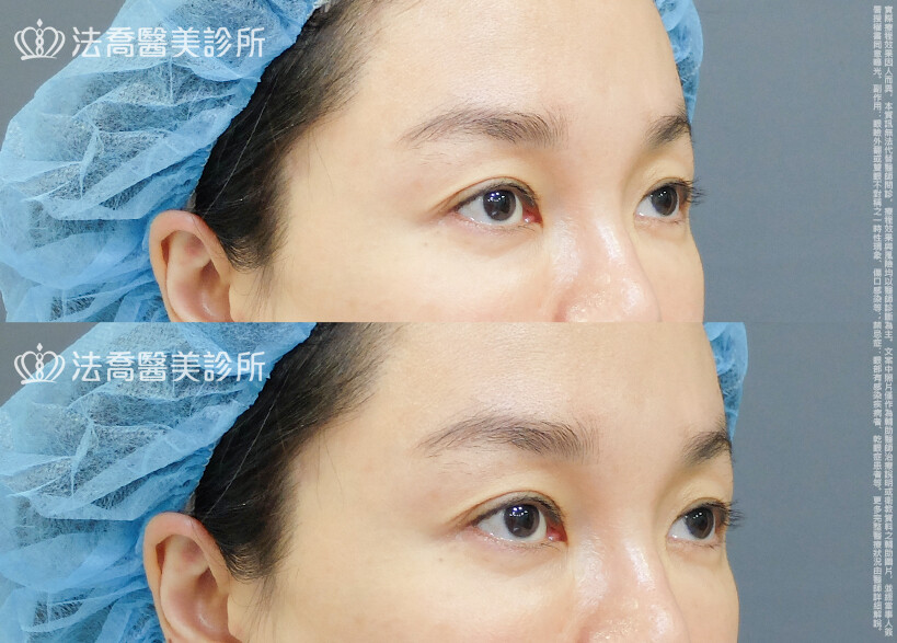 法喬醫美診所,邱浚彥,割雙眼皮
