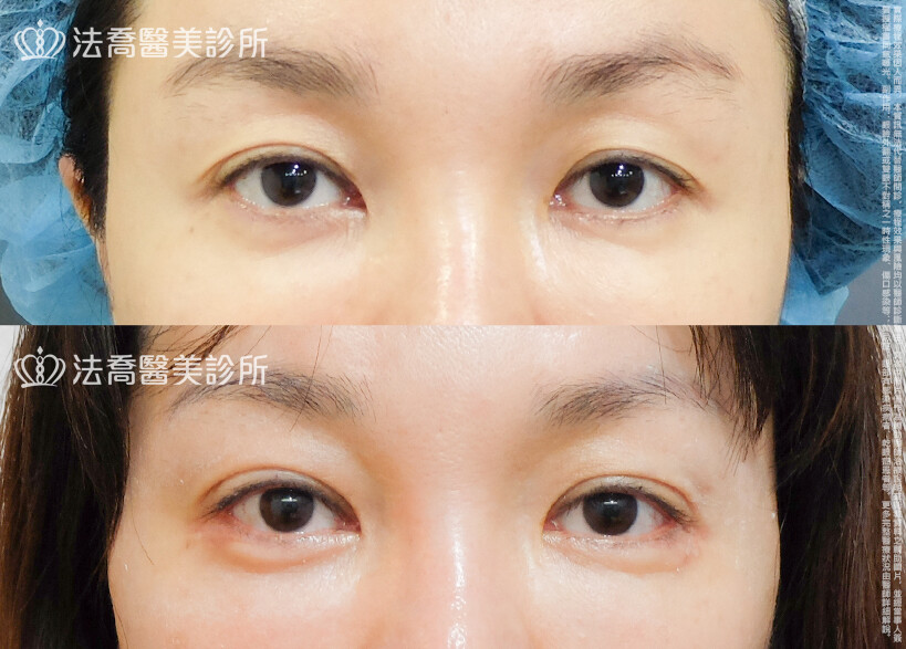 法喬醫美診所,邱浚彥,割雙眼皮