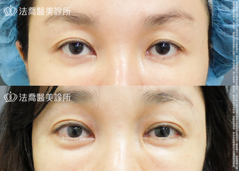 法喬醫美診所,邱浚彥,割雙眼皮