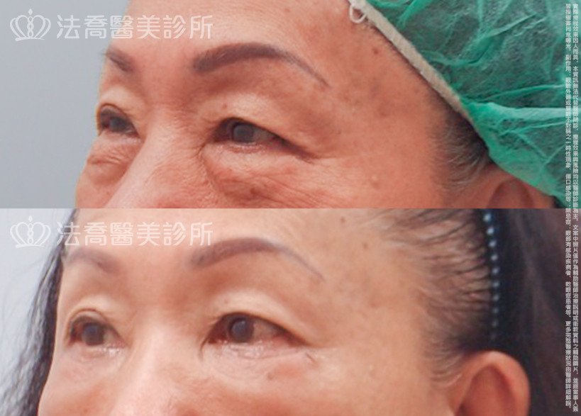 法喬醫美診所,邱浚彥醫師,眼袋內開