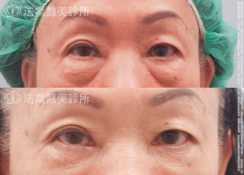 法喬醫美診所,邱浚彥醫師,眼袋內開