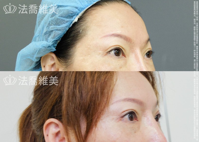 法喬醫美診所,邱浚彥,眼袋內開