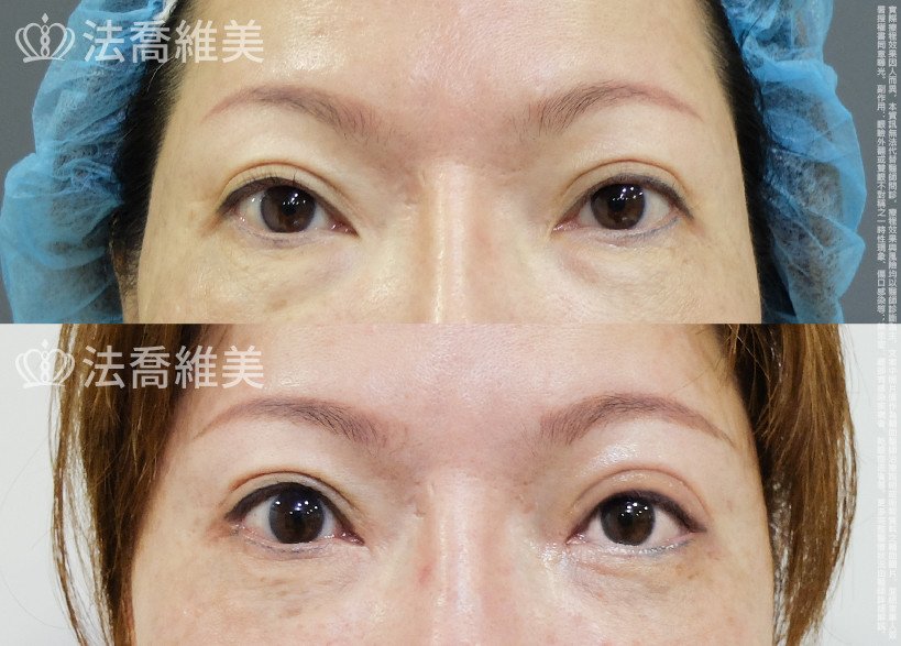 法喬醫美診所,邱浚彥,眼袋內開