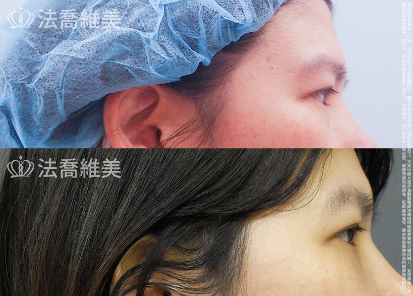 法喬醫美診所,邱浚彥,眼袋內開