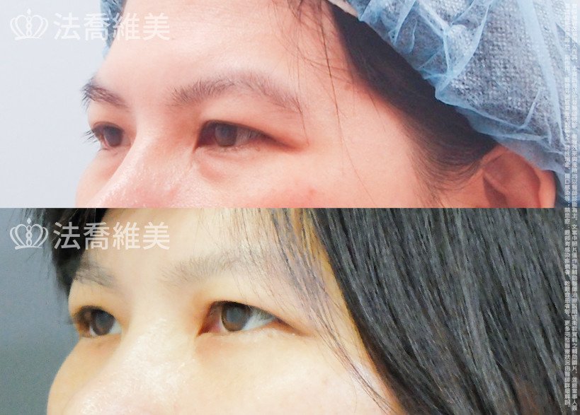 法喬醫美診所,邱浚彥,眼袋內開