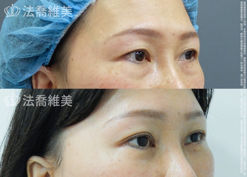 法喬醫美診所 邱浚彥醫師,眼袋內開