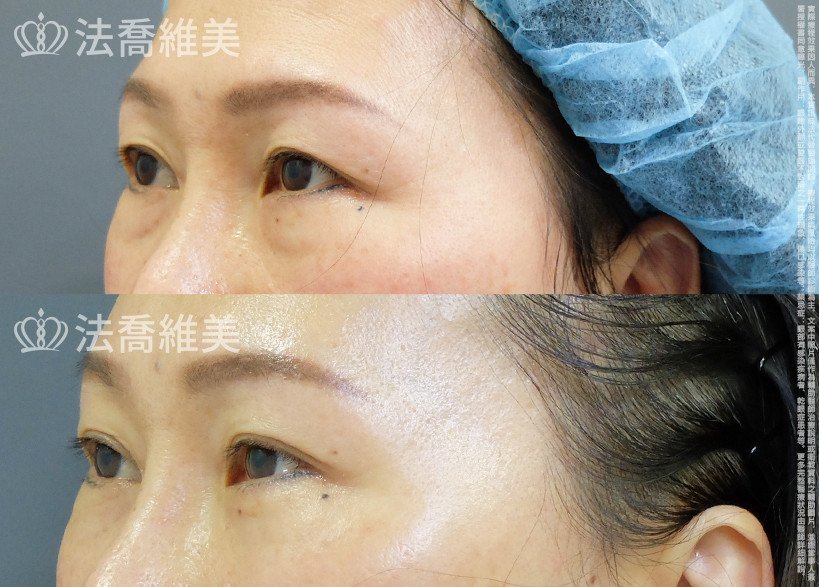 法喬醫美診所 邱浚彥醫師,縫雙眼皮