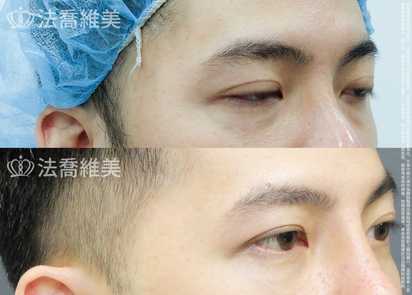 法喬醫美診所 邱浚彥醫師,眼袋內開