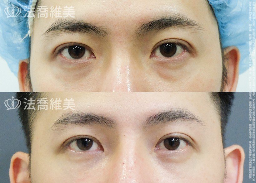 法喬醫美診所 邱浚彥醫師,眼袋內開