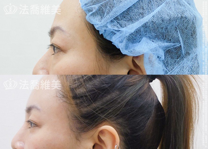 法喬醫美診所 邱浚彥醫師,眼袋內開