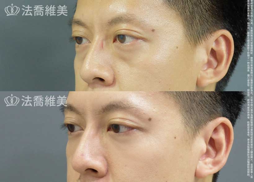 眼袋內開+補蘋果肌