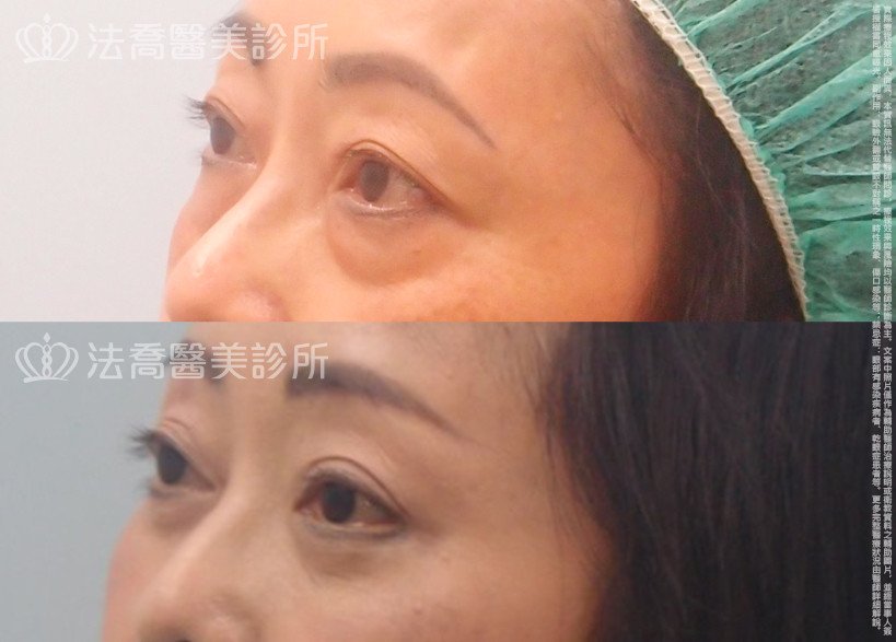 法喬醫美診所,邱浚彥,眼袋外開,切眉