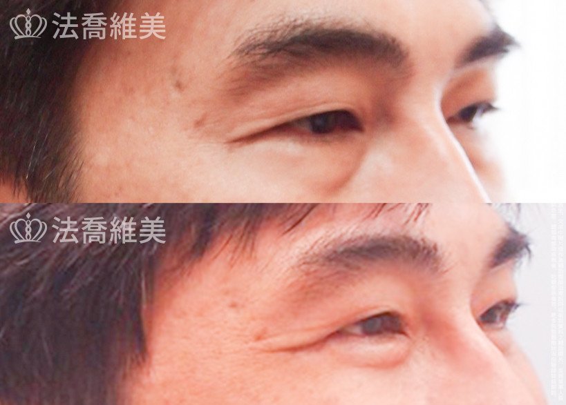 法喬醫美診所,邱浚彥醫師,眼袋外開