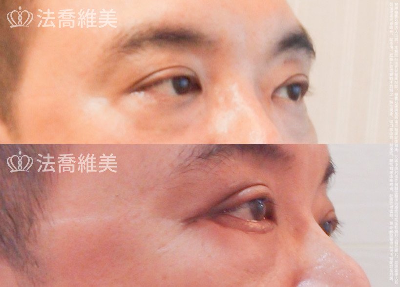 法喬醫美診所,邱浚彥醫師,眼袋外開