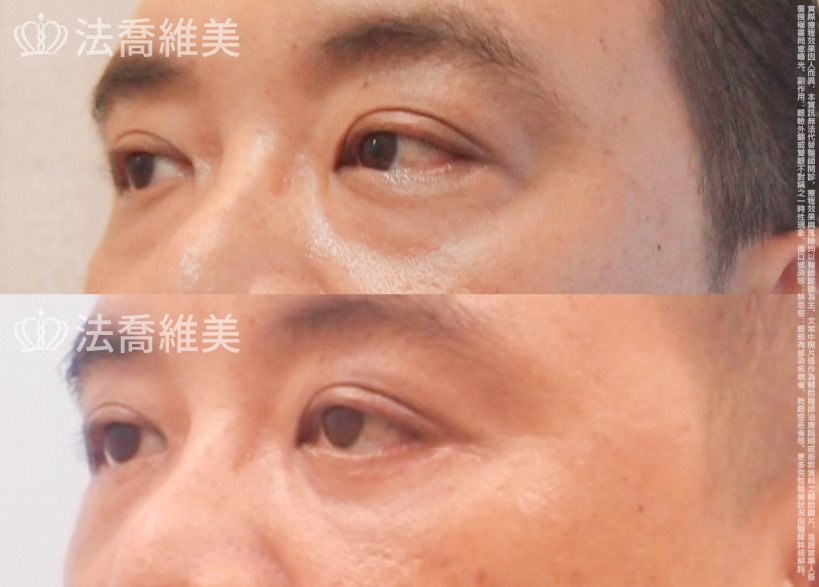 法喬醫美診所,邱浚彥醫師,眼袋外開