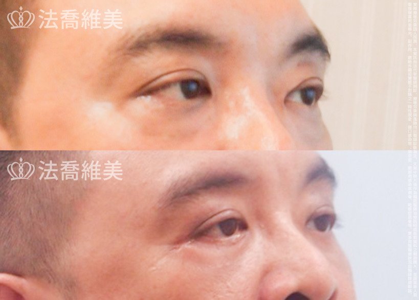 法喬醫美診所,邱浚彥醫師,眼袋外開
