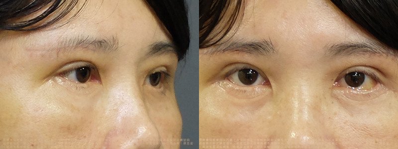 邱浚彥醫師眼袋案例_切眉+眼袋外開脂肪移位