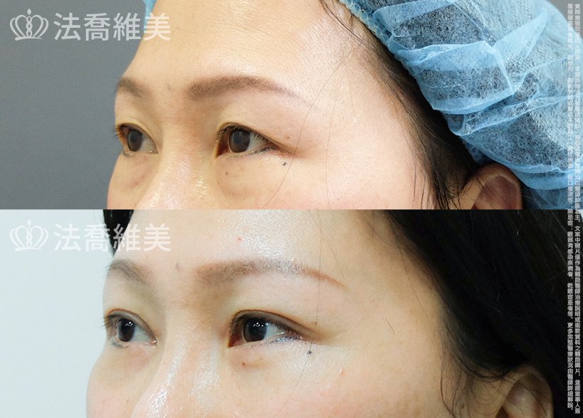 法喬醫美診所 邱浚彥醫師,縫雙眼皮