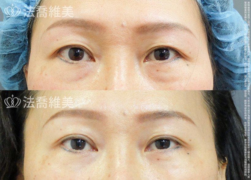 法喬醫美診所 邱浚彥醫師,縫雙眼皮