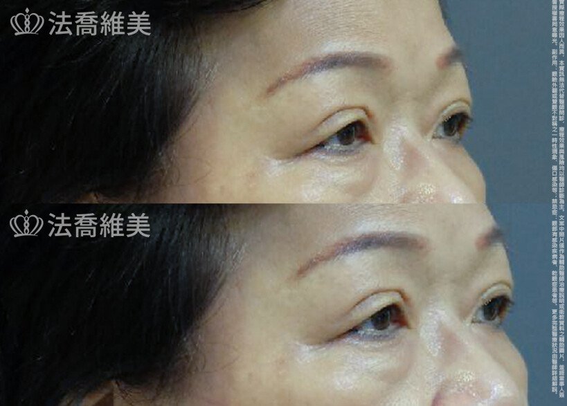 法喬醫美診所 邱浚彥醫師,縫雙眼皮