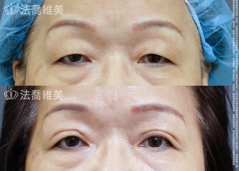法喬醫美診所 邱浚彥醫師,縫雙眼皮