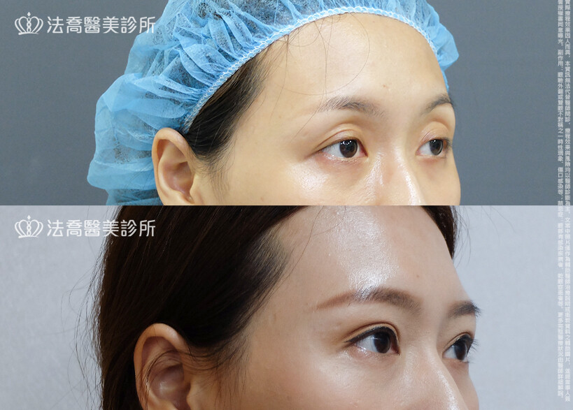 雙眼皮重修