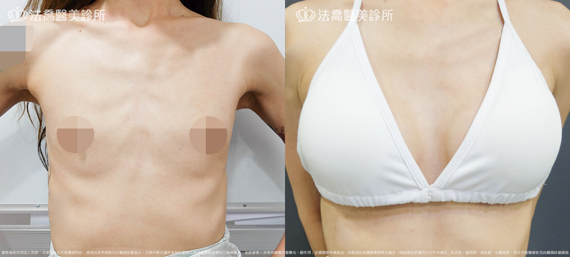 法喬醫美診所,邱浚彥,圓盤果凍矽膠隆乳