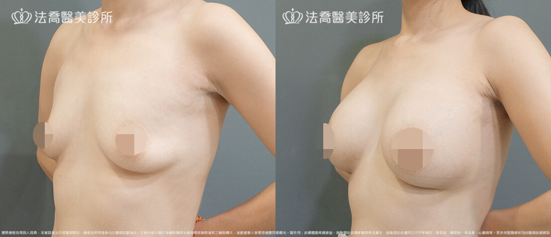 法喬醫美診所,邱浚彥,圓盤果凍矽膠隆乳