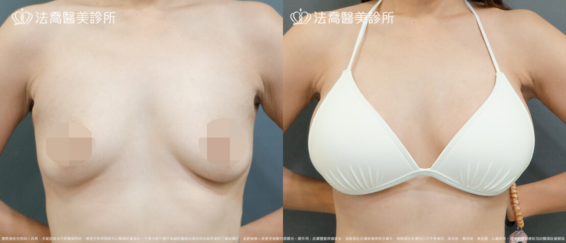 法喬醫美診所,邱浚彥,圓盤果凍矽膠隆乳