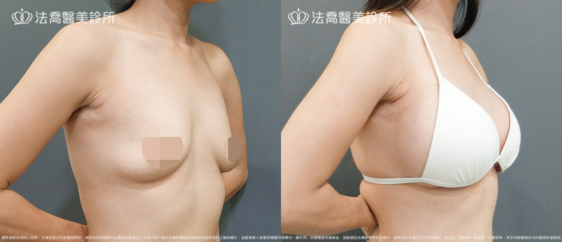 法喬醫美診所,邱浚彥,圓盤果凍矽膠隆乳