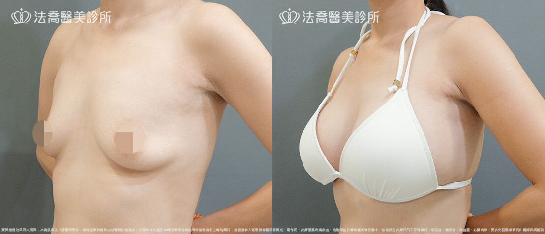 法喬醫美診所,邱浚彥,圓盤果凍矽膠隆乳