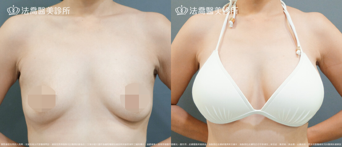 法喬醫美診所,邱浚彥,圓盤果凍矽膠隆乳