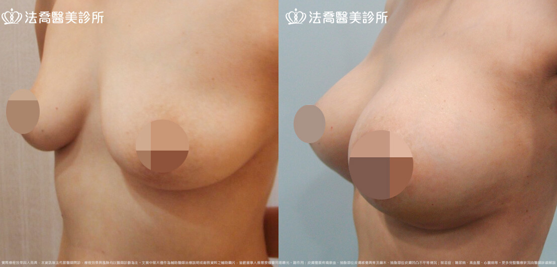 法喬醫美診所,邱浚彥,圓盤果凍矽膠隆乳