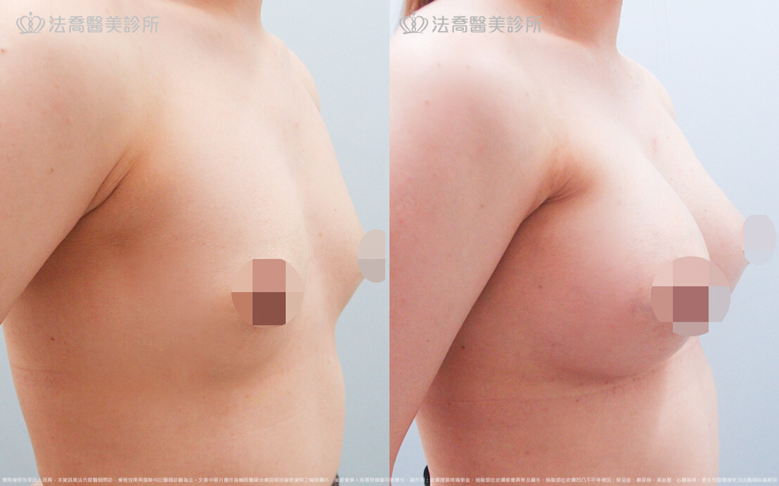 法喬醫美診所,邱浚彥,圓盤果凍矽膠隆乳