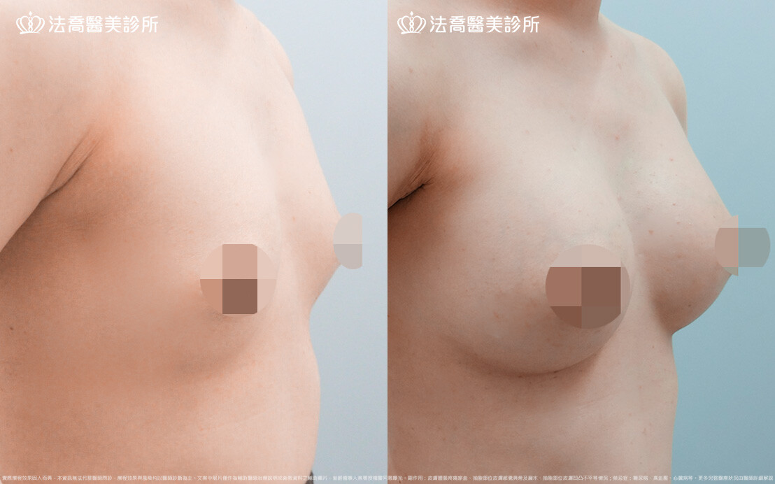 法喬醫美診所,邱浚彥,圓盤果凍矽膠隆乳